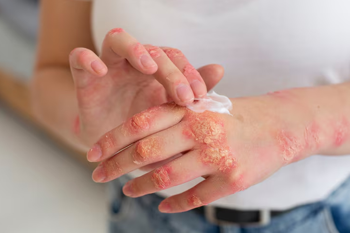 Fungal Infection Therapy