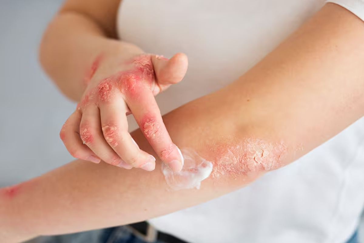 Chronic Skin Allergy