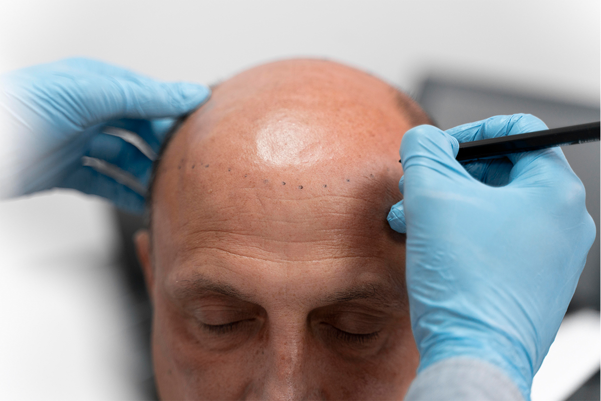 Hair Transplant